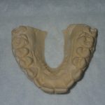 Dental Cast to be scanned for tooth movement