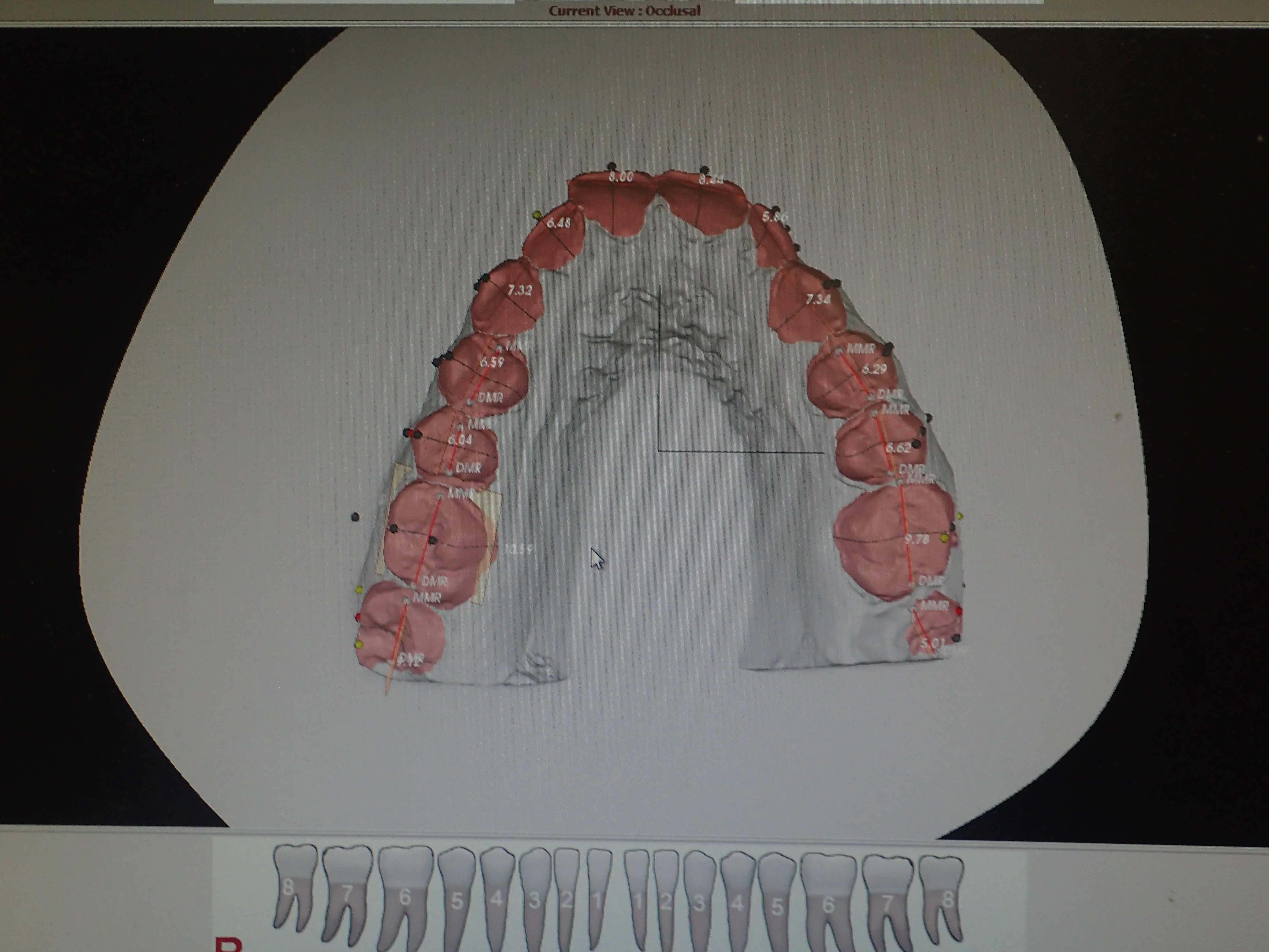 Scanned dental model  is then digitized into Motion View software