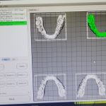 Once the tooth movement is prescribed and the number of aligners needed.  The 3D models are sent to the printer