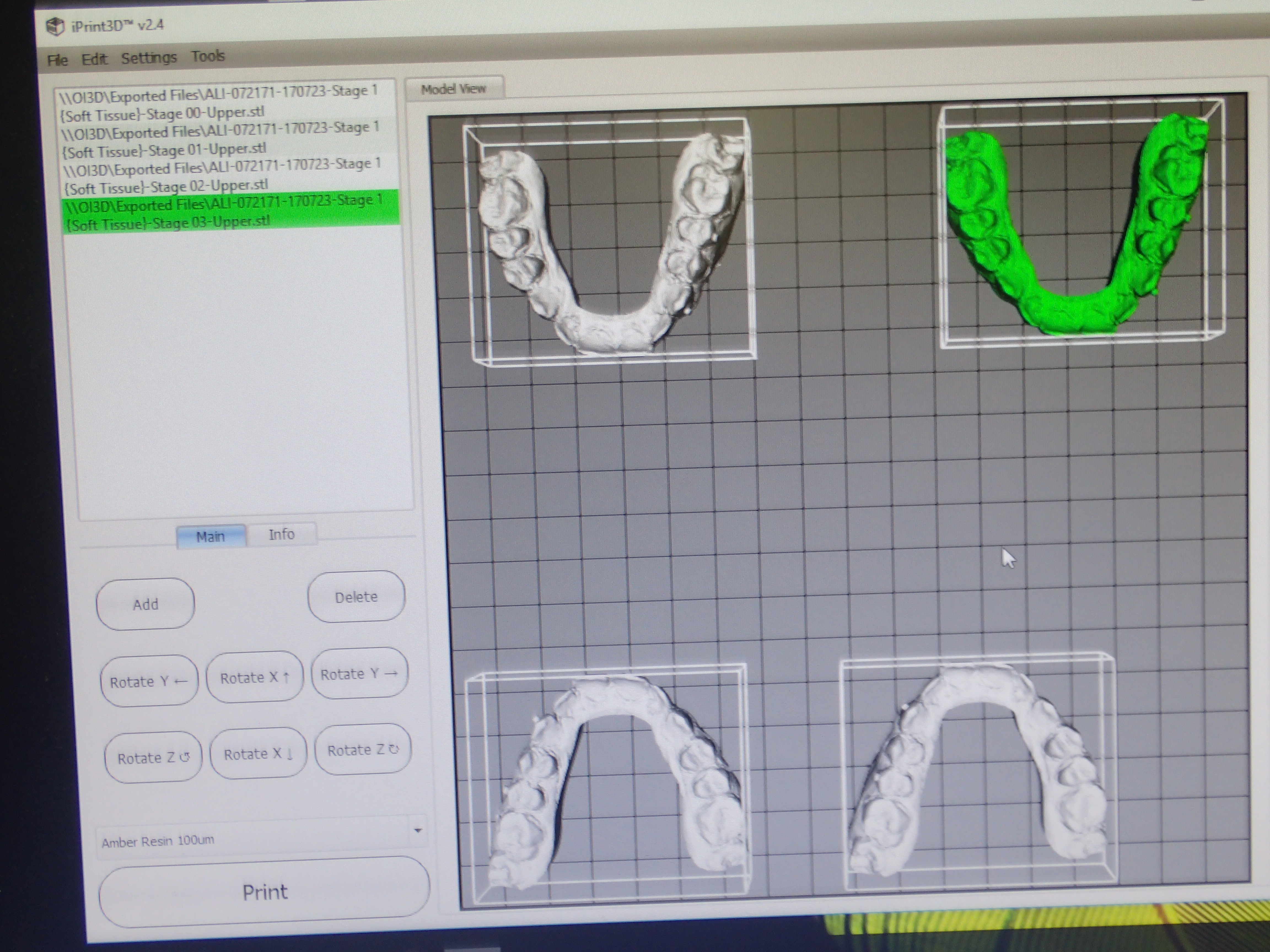 Once the tooth movement is prescribed and the number of aligners needed.  The 3D models are sent to the printer