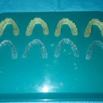 Aligners are made from 3 D printed models (with prescribed tooth movement) and trimmed and polished in preparation for delivery to the patient.