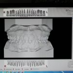 Example of Scanned dental impressions made into computer generated 3D models