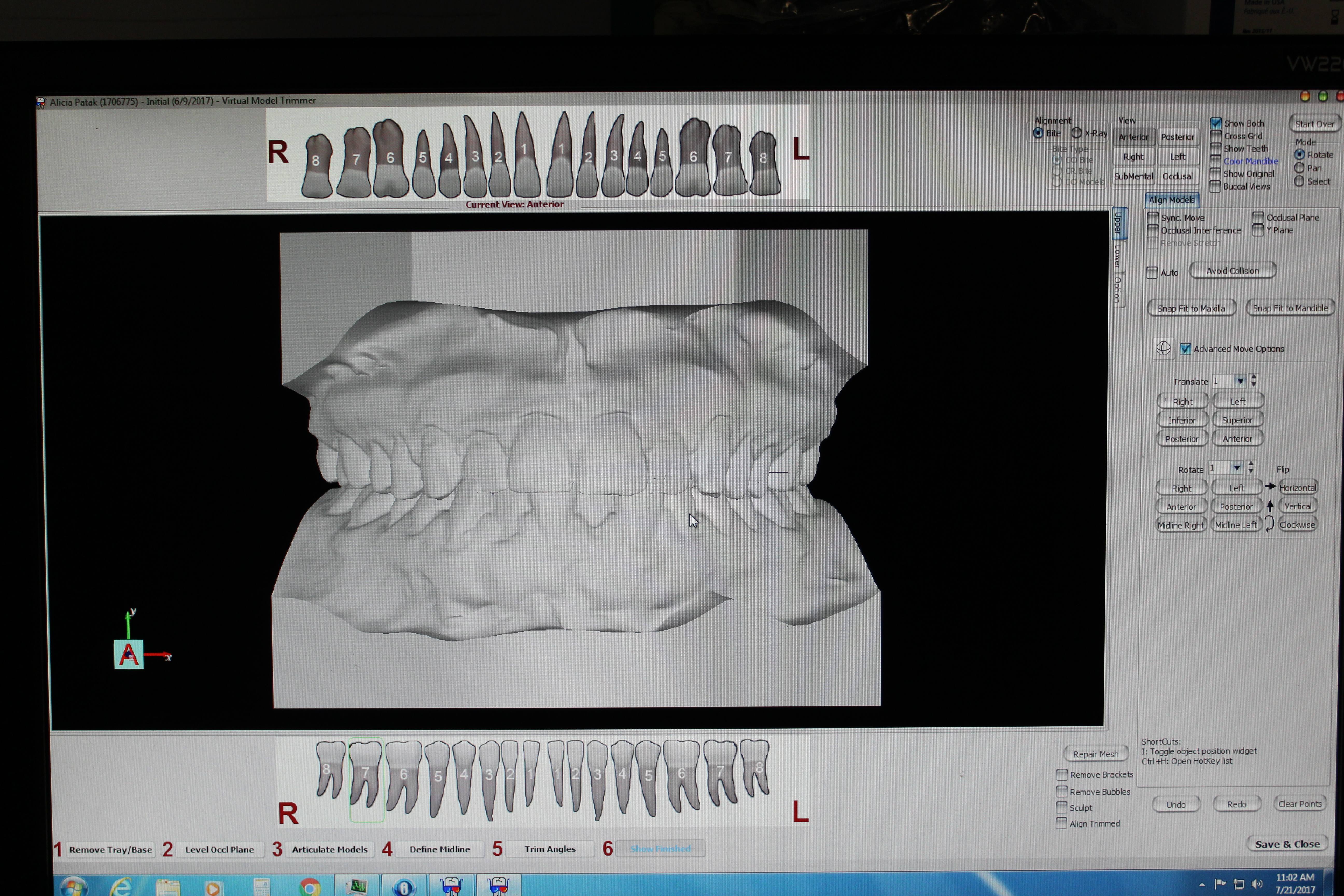 Example of Scanned dental impressions made into computer generated 3D models