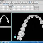 Using software, the teeth can be moved at the Doctor’s discretion and in increments that Doctor feels  is appropriate for this patient.