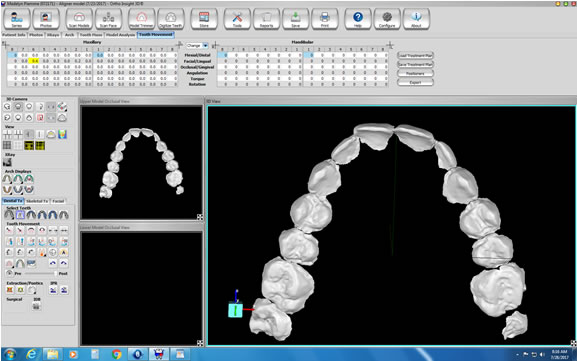 Using software, the teeth can be moved at the Doctor’s discretion and in increments that Doctor feels  is appropriate for this patient.
